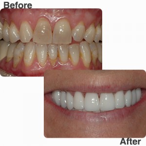 before-and-after-slide