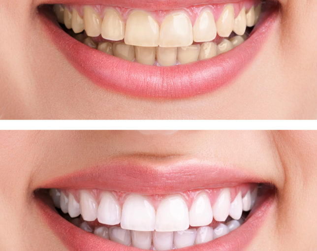 teeth whitening, Teeth Whitening, Sanchez Dental