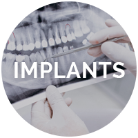 Dental Implants, Albuquerque’s Local Dental Implants, Sanchez Dental